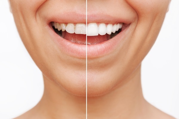 What To Ask Your Dentist About Getting Veneers